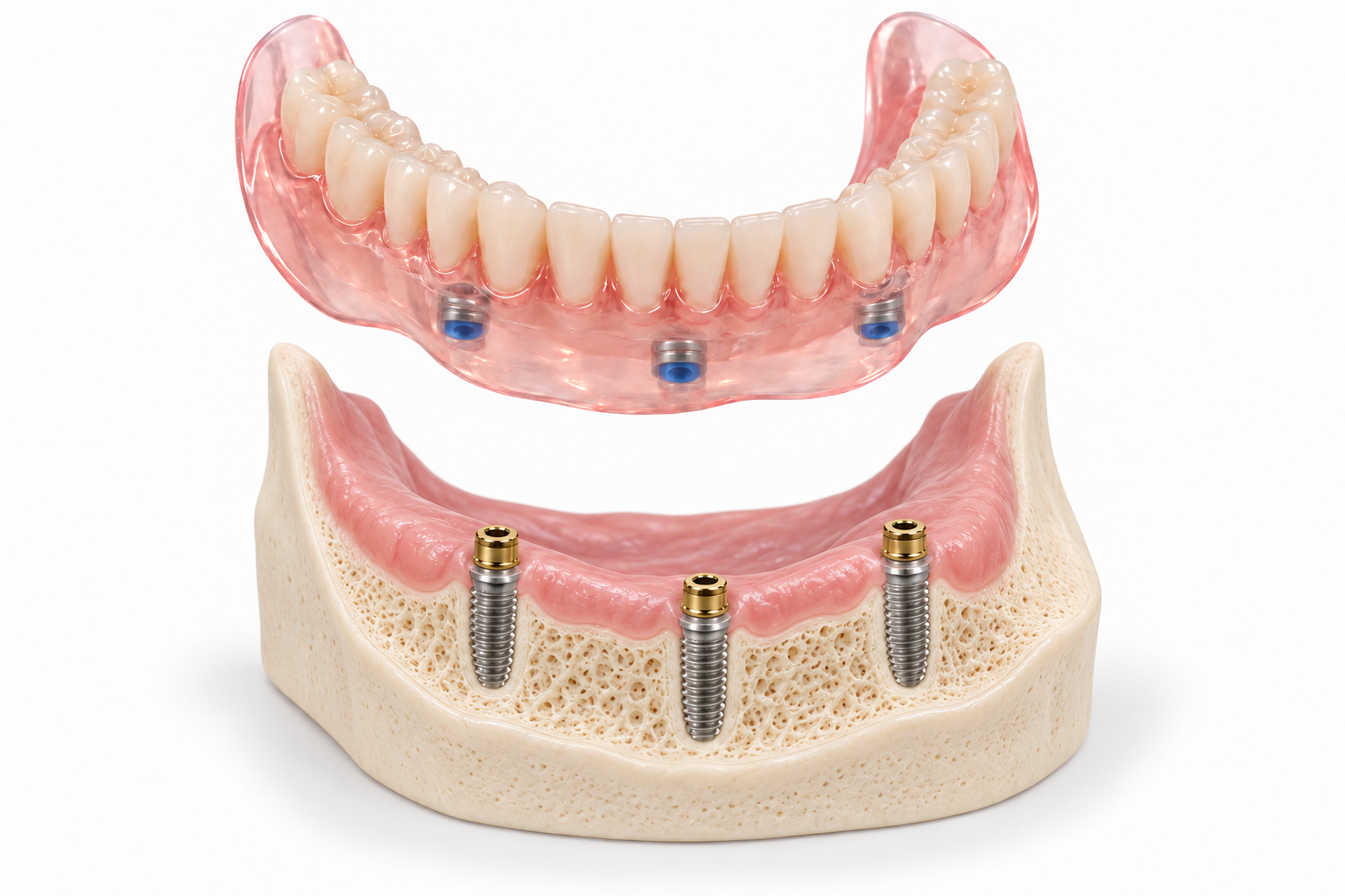 Bone-and-gum jaw model showing three implants beneath a clear pink snap-on denture with full flanges and silver Zest-style housings containing blue inserts
